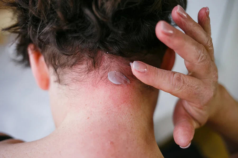 Dermatitis Seborreica