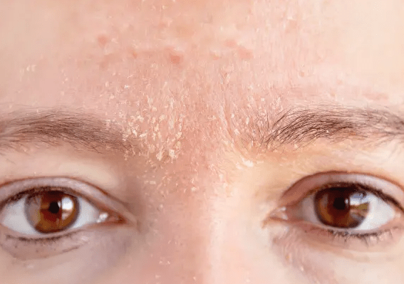 Piel deshidratada - TIENDA PIEL