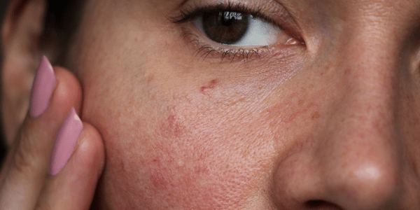 Piel sensible - TIENDA PIEL