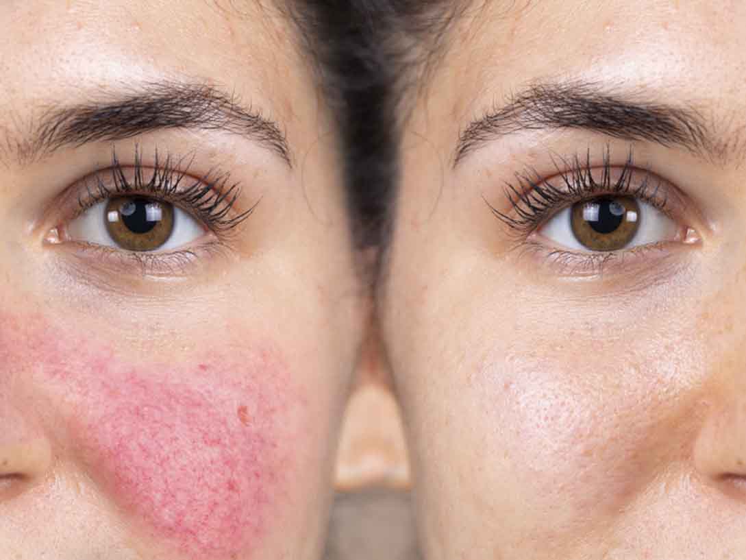 Rosacea - TIENDA PIEL